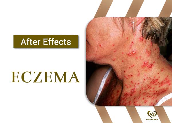 Eczema mobile