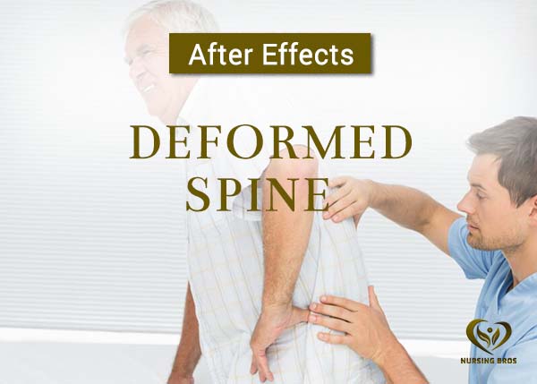 deformed spine mobile